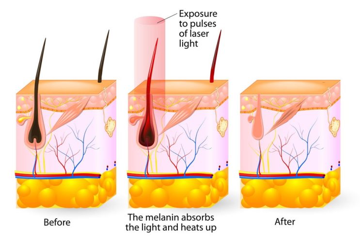 How do laser hair removal devices work