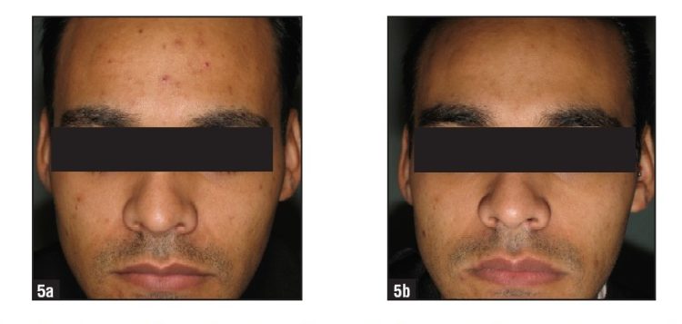 led therapy for acne before and after