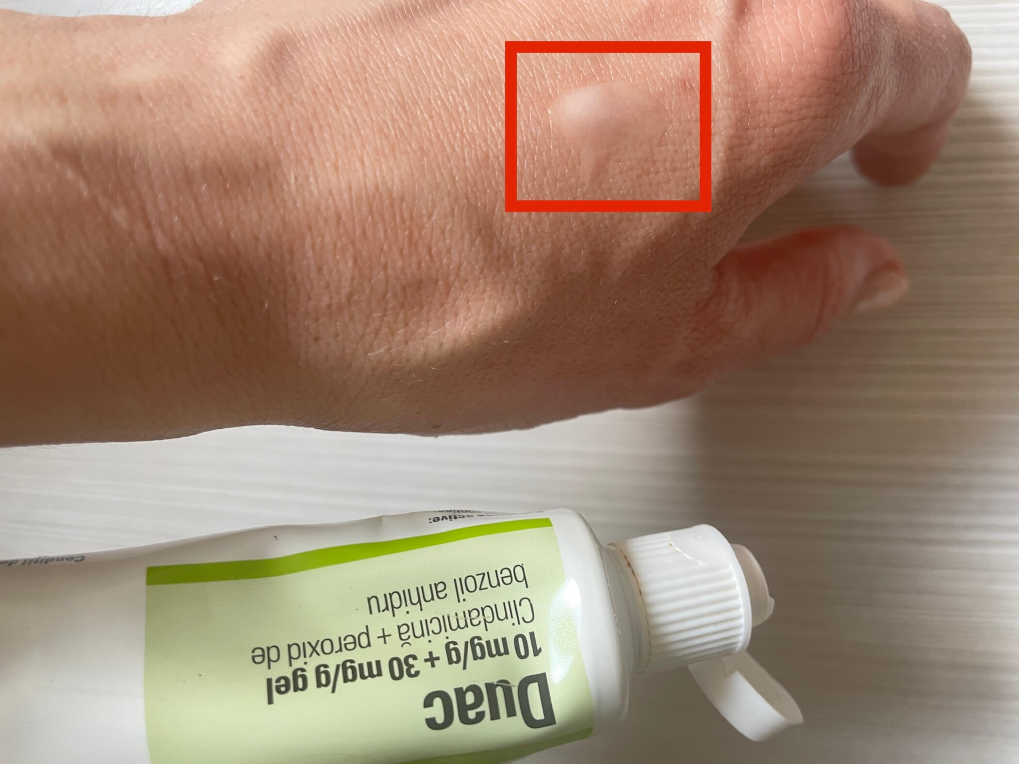 recommended amount of benzoyl peroxide to apply on skin