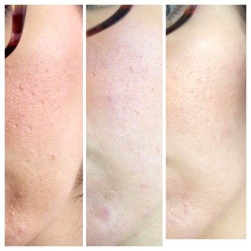 TCA Peels (Trichloroacetic Acid) Benefits and What To Expect