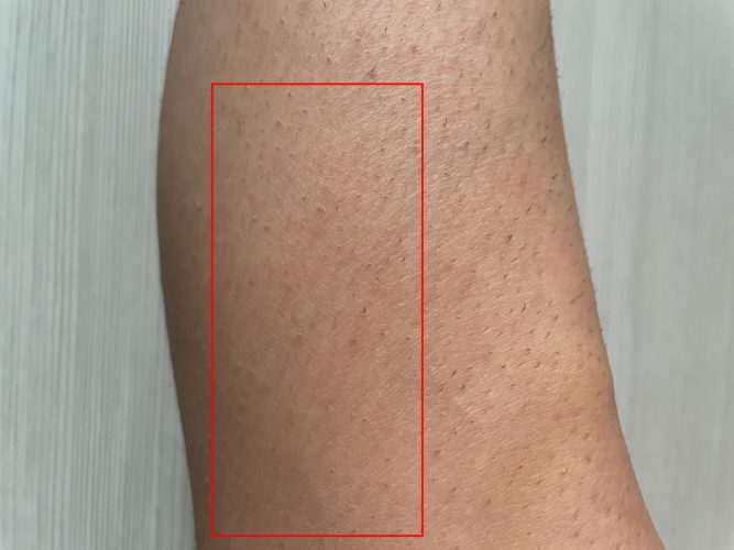IPL Hair Removal After Results