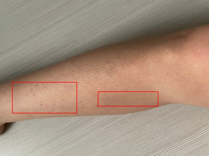 IPL Hair Removal Results