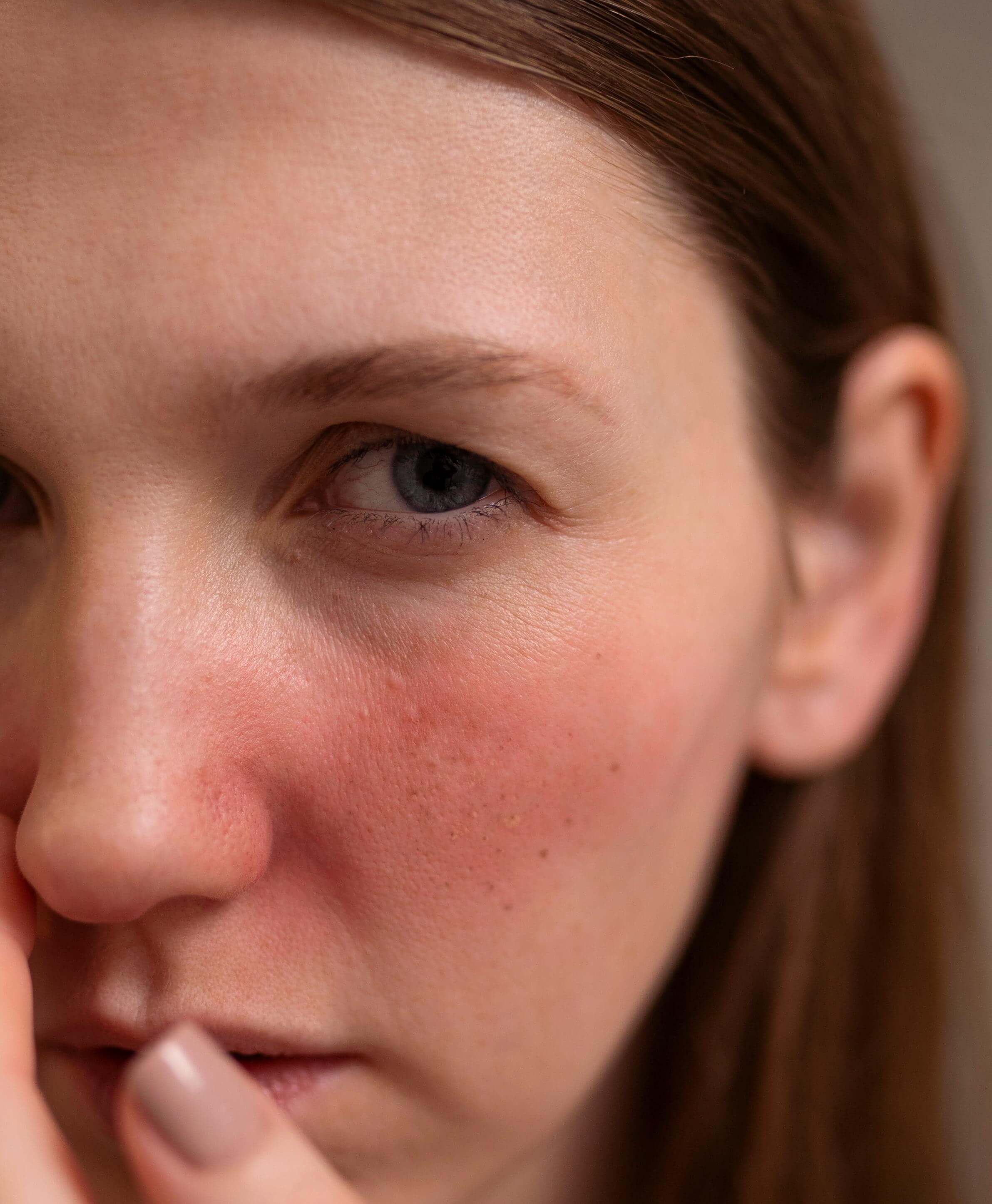 Signs of retinol burns